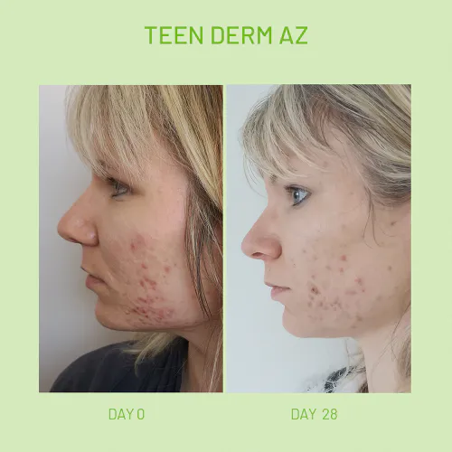 Isispharma Teen Derm A.Z 30 ml